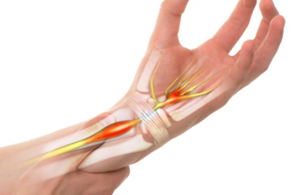 Recognizing Carpal Tunnel Syndrome and Its Warning Signs